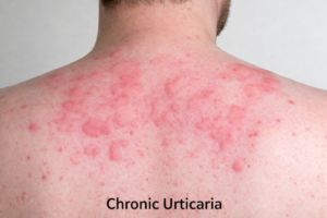 Fexon 120 mg tablet uses